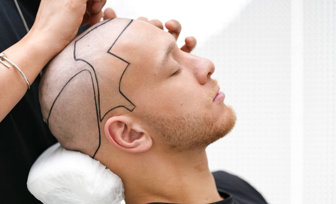 Hair Transplant Cost UK vs Turkey